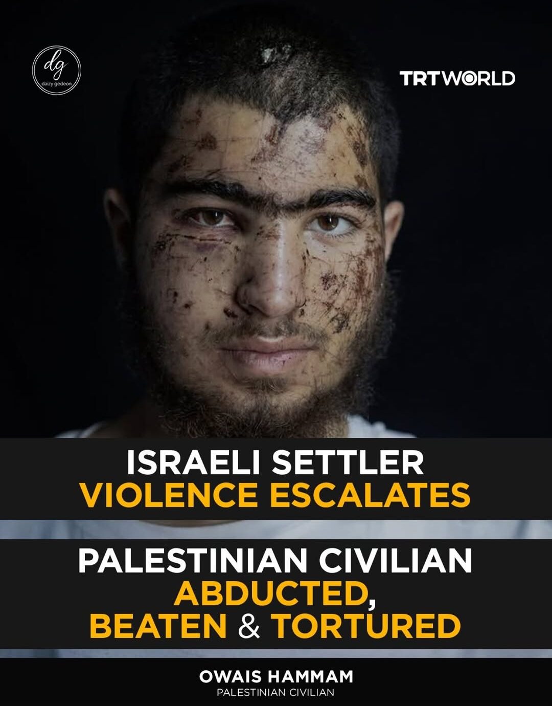 Israeli Settler Violence Escalates as Palestinian Civilian Owais Hammam Is Abducted, Beaten and Tortured – TRTWorld